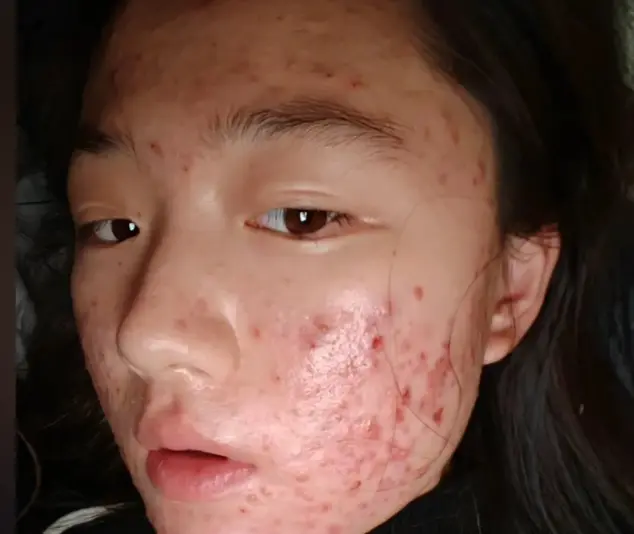 冬季皮肤敏感容易长长痘怎么应对解决呢