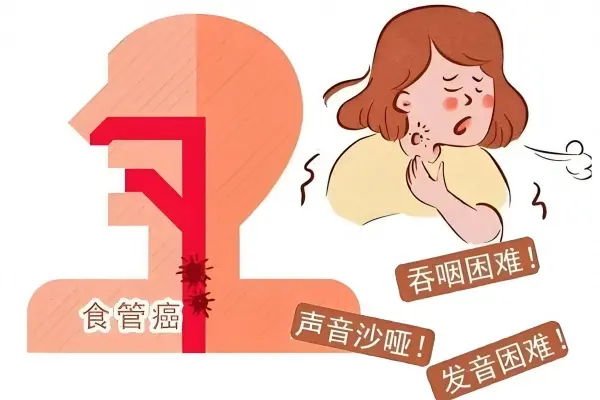 哪些习惯会伤食管？如何预防食管癌？