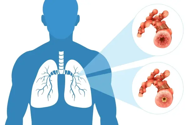 什么是痰湿体质？如何调理痰湿体质？