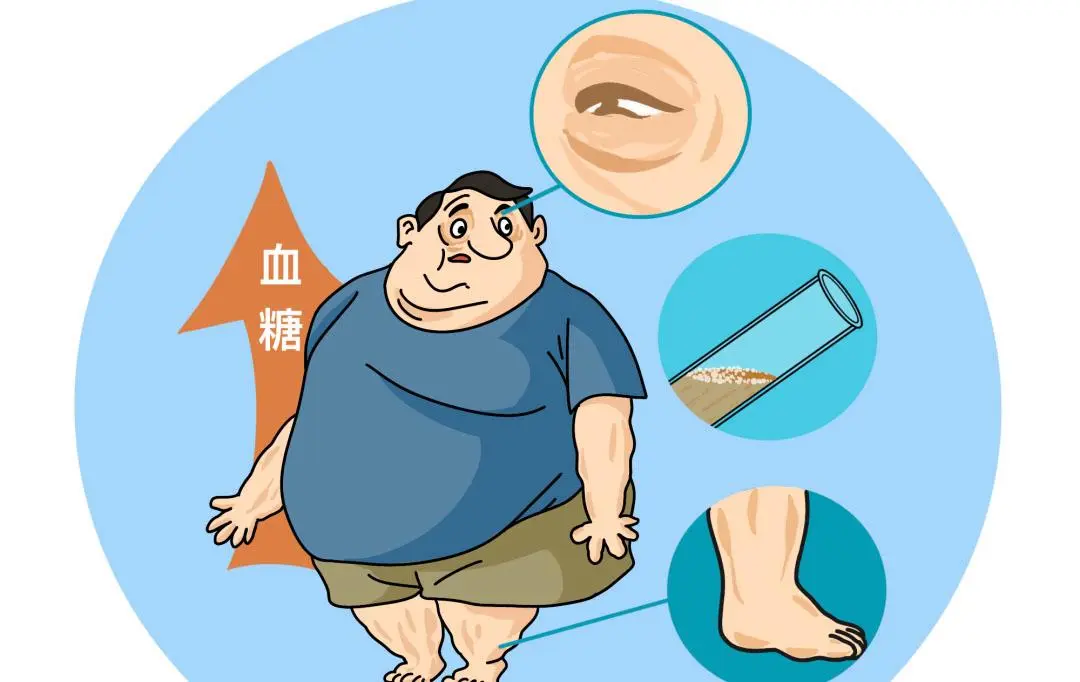 研究显示：&ldquo;屁股形状&rdquo;或可预测糖尿病，特定臀形患病风险高