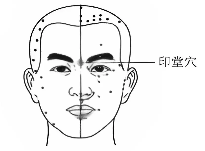 印堂穴